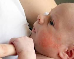 Çocuklarda Besin Alerjileri Şanlıurfa